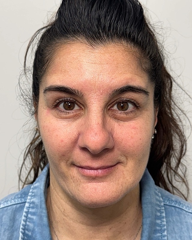 Botox Before & After