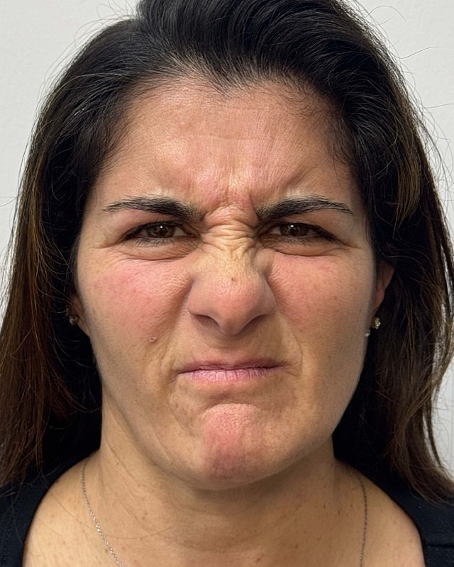 Botox Before & After