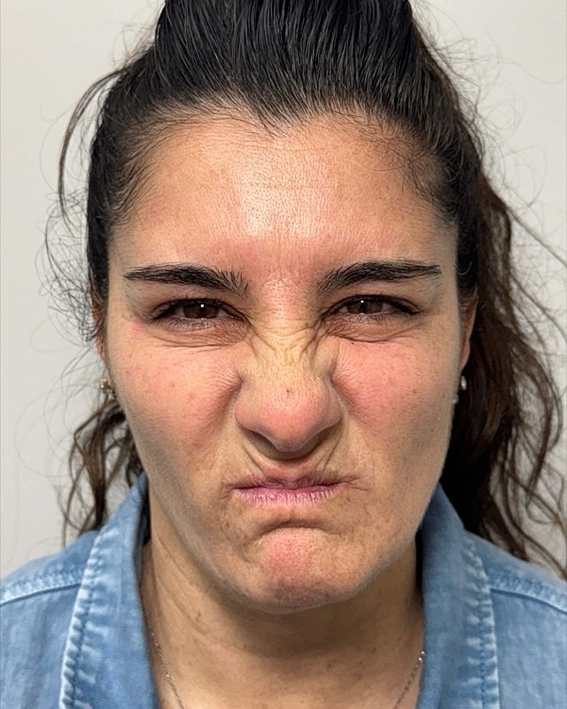 Botox Before & After