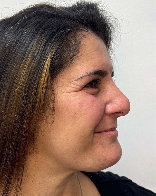Botox Before & After