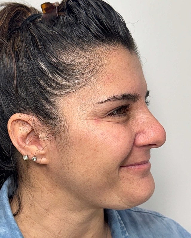 Botox Before & After