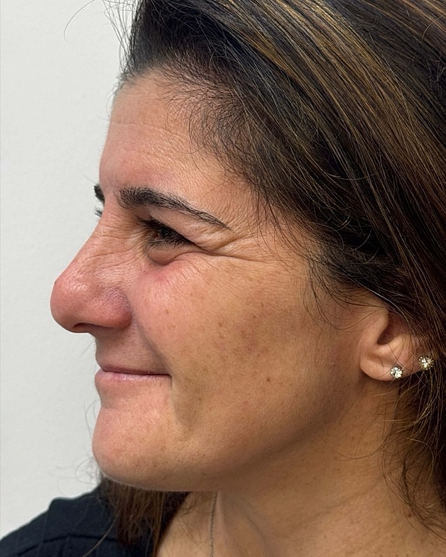 Botox Before & After