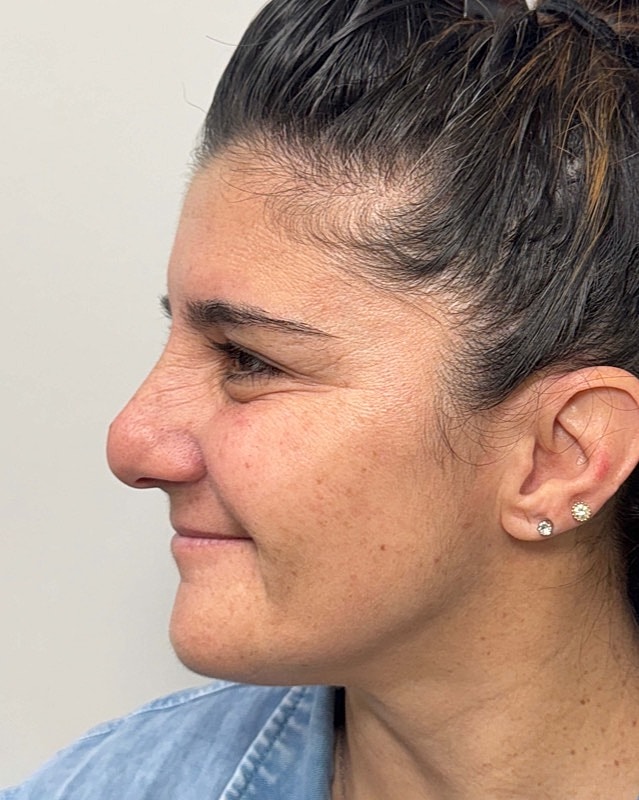 Botox Before & After