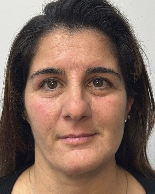 Botox Before & After