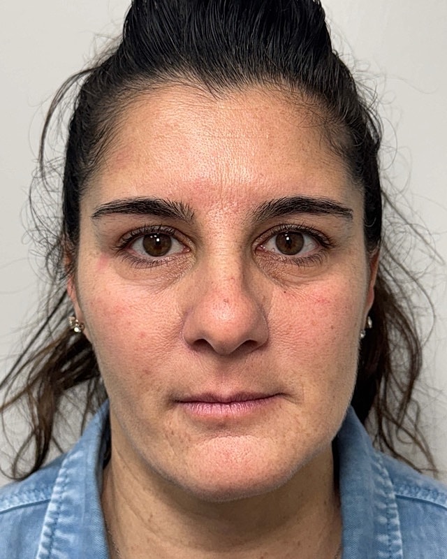 Botox Before & After