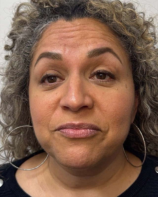 Botox Before & After