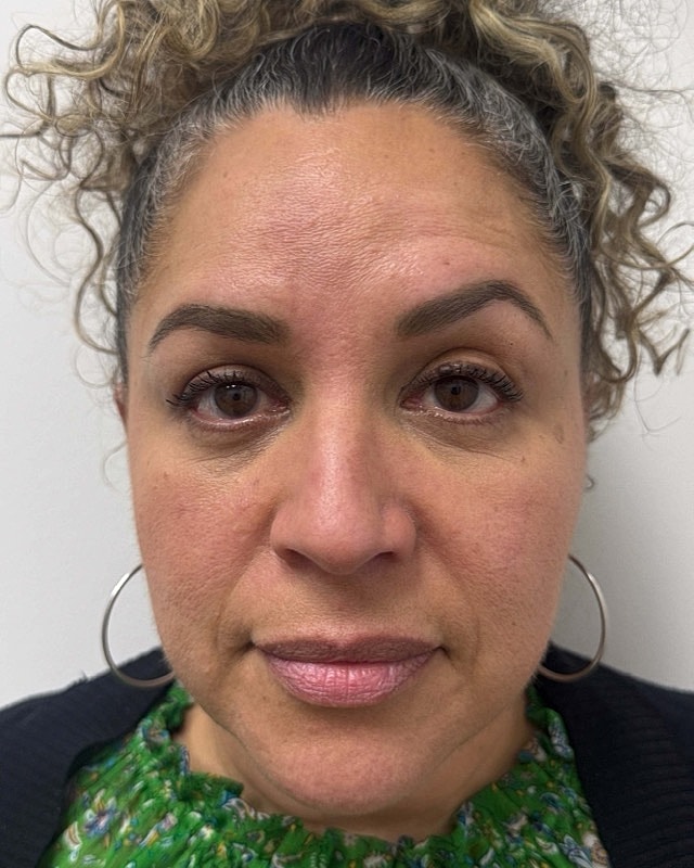 Botox Before & After