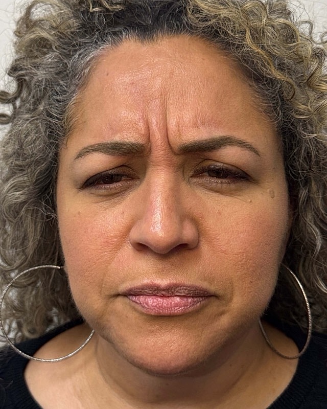 Botox Before & After