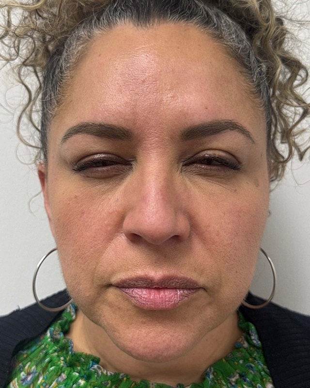 Botox Before & After