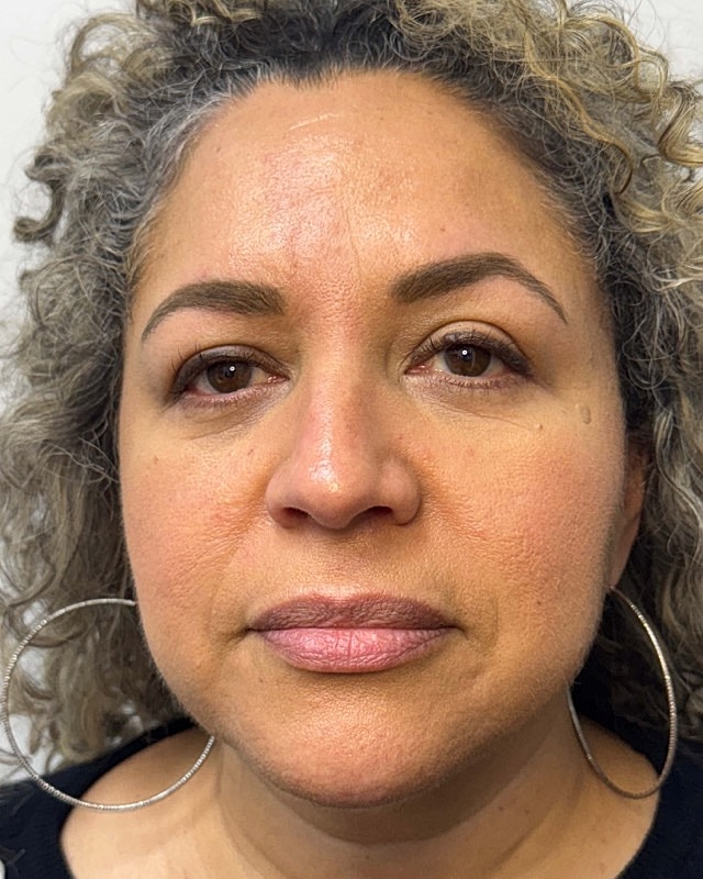 Botox Before & After