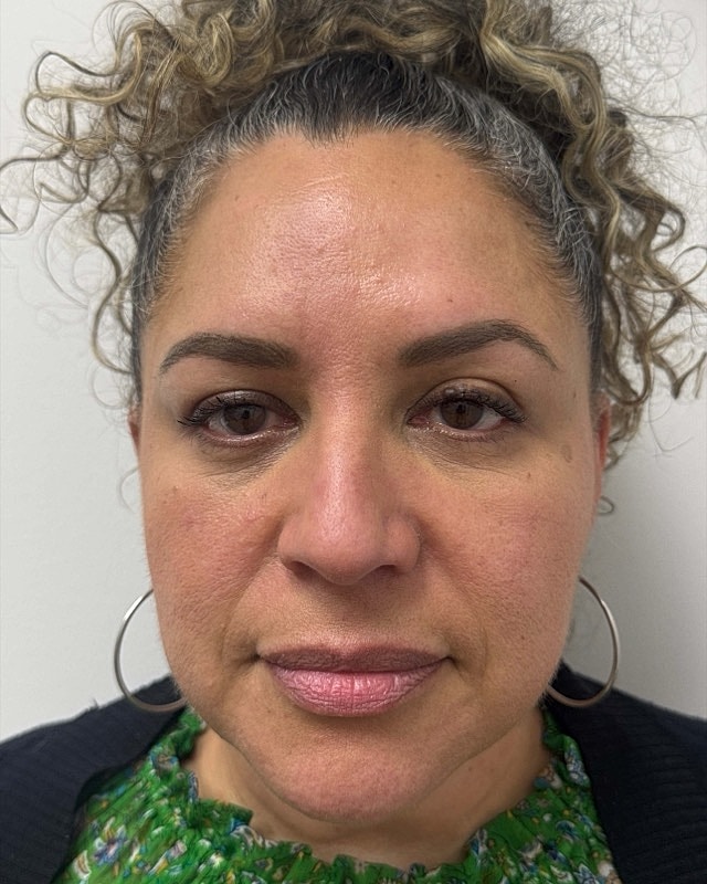 Botox Before & After