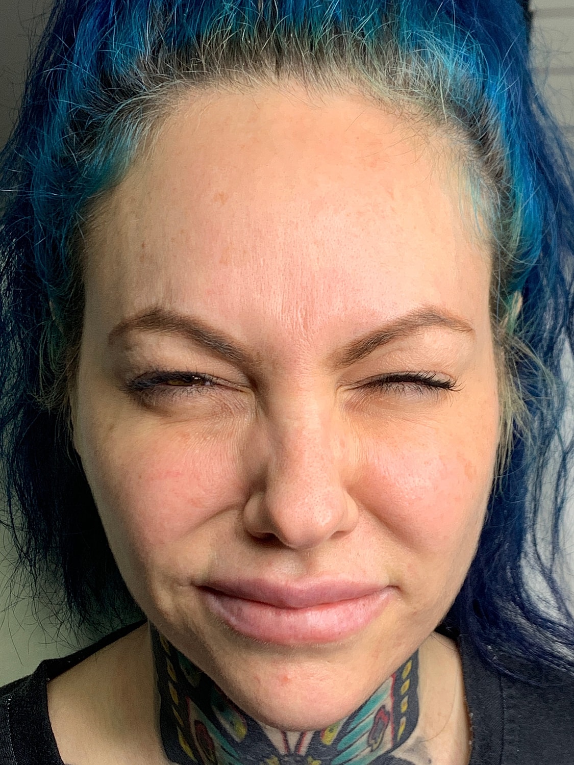 Facial Balancing Before & After