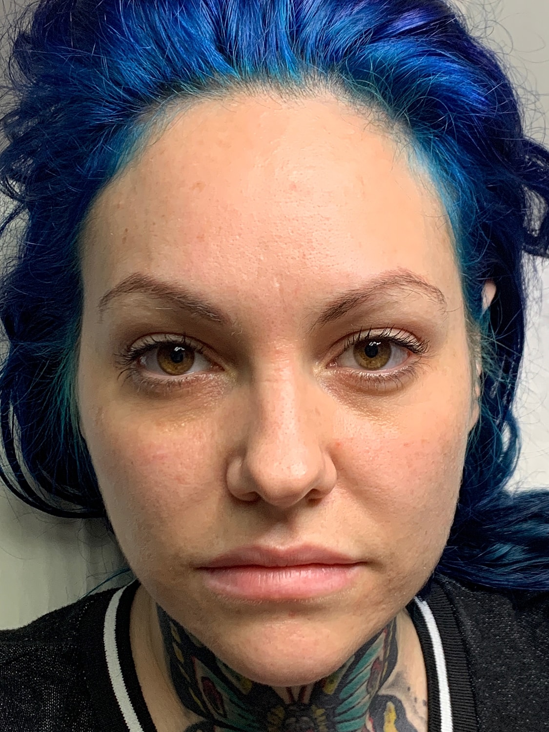 Facial Balancing Before & After