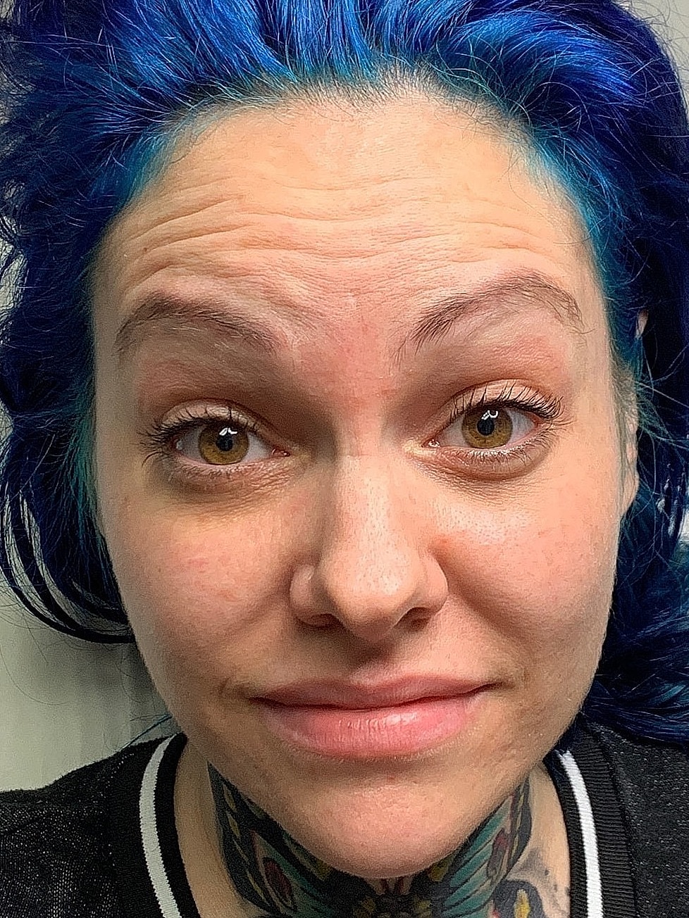 Facial Balancing Before & After
