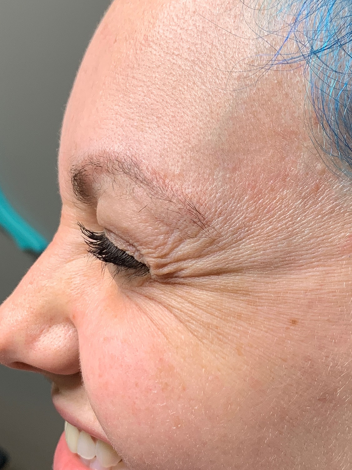 Wrinkle Treatments Before & After