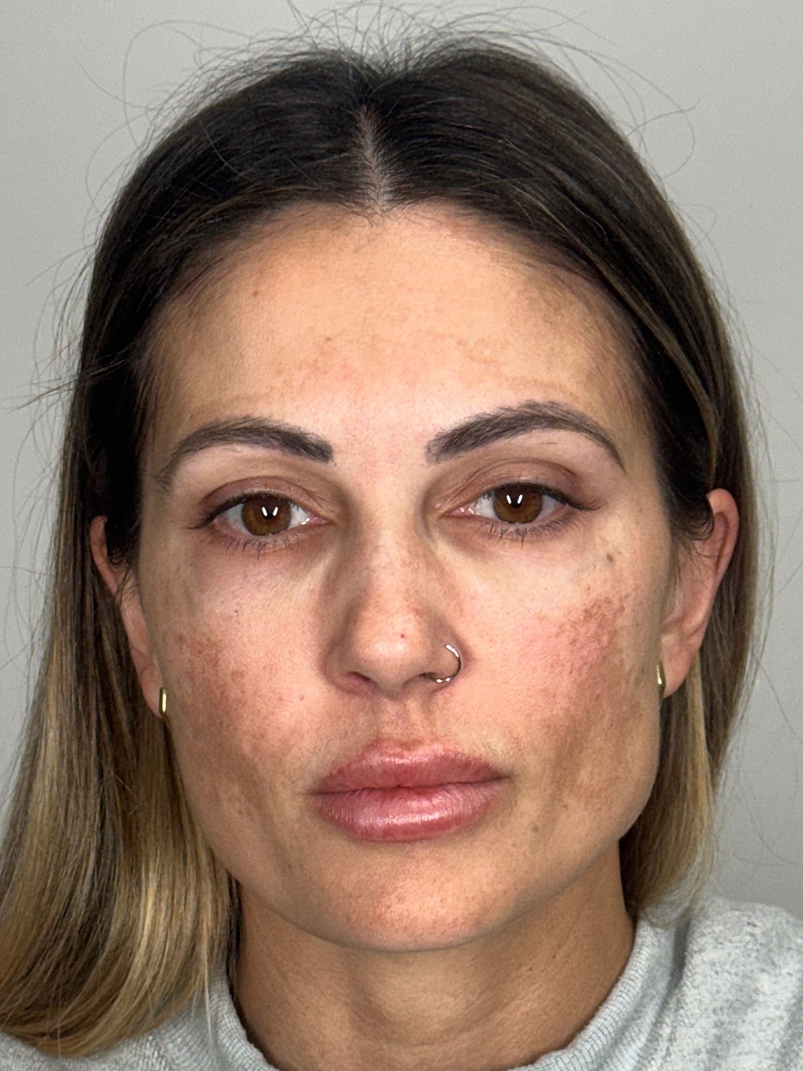 Wrinkle Treatments Before & After