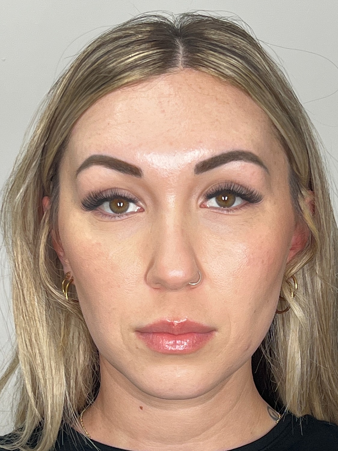 Wrinkle Treatments Before & After