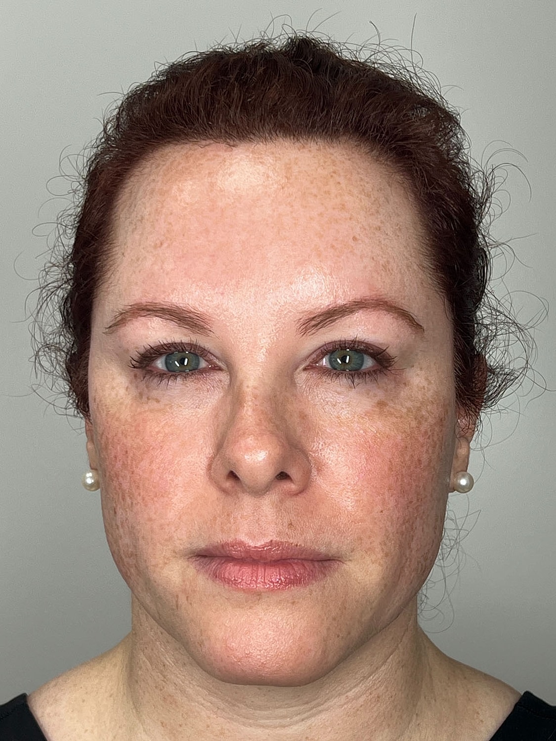 Wrinkle Treatments Before & After
