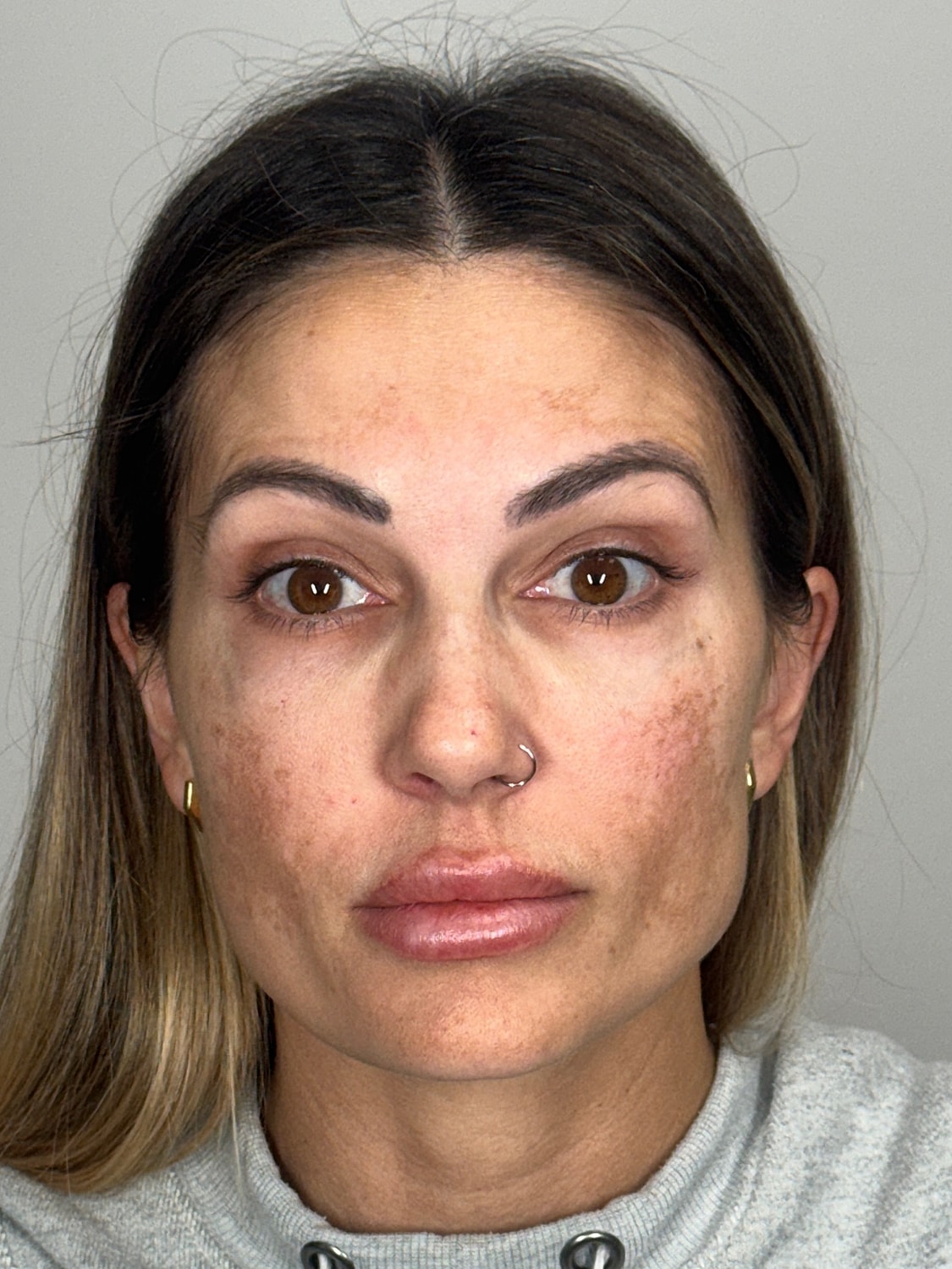 Wrinkle Treatments Before & After
