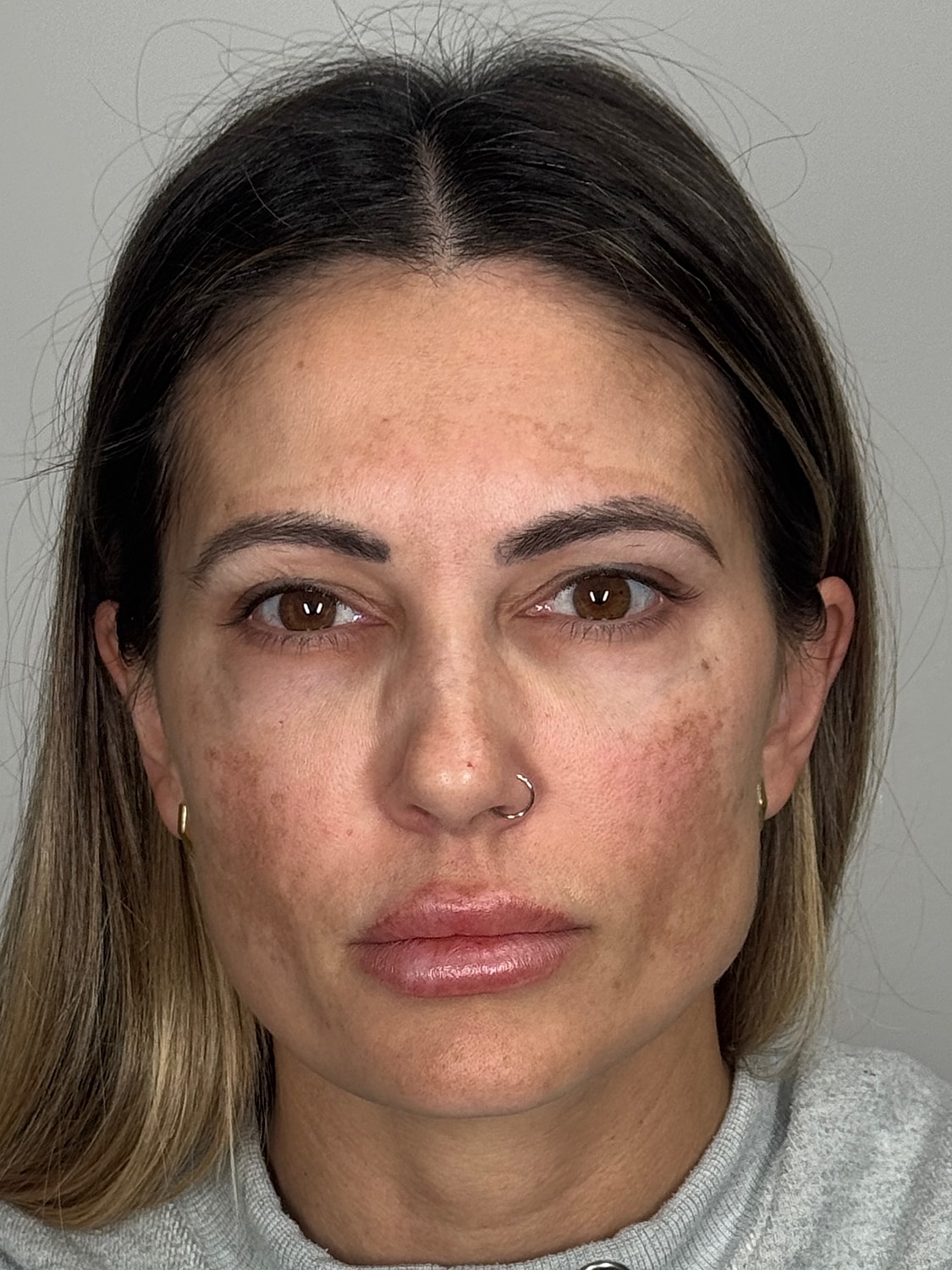Wrinkle Treatments Before & After