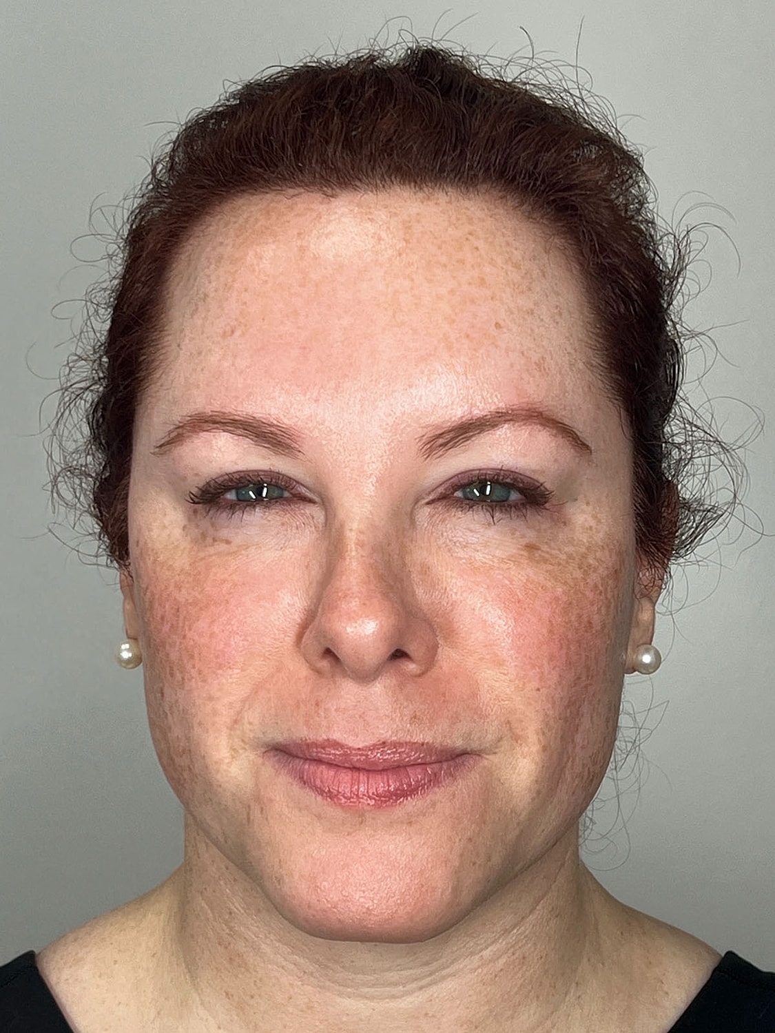 Wrinkle Treatments Before & After