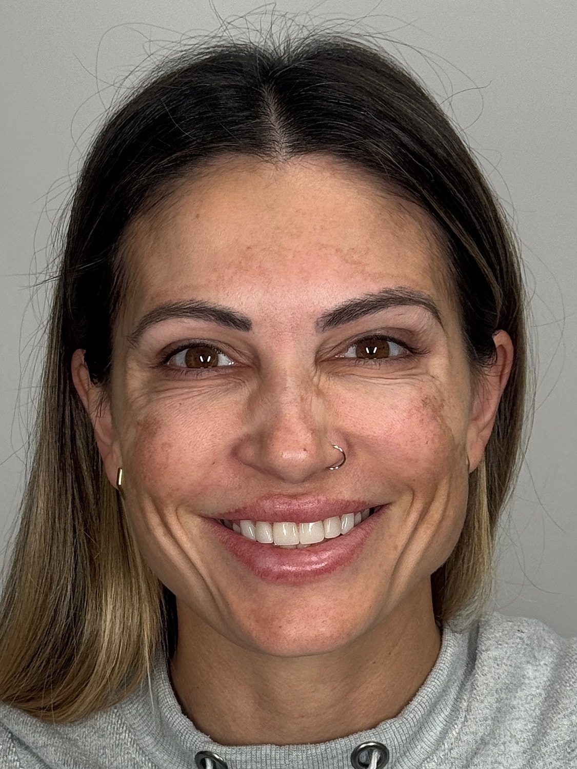 Wrinkle Treatments Before & After