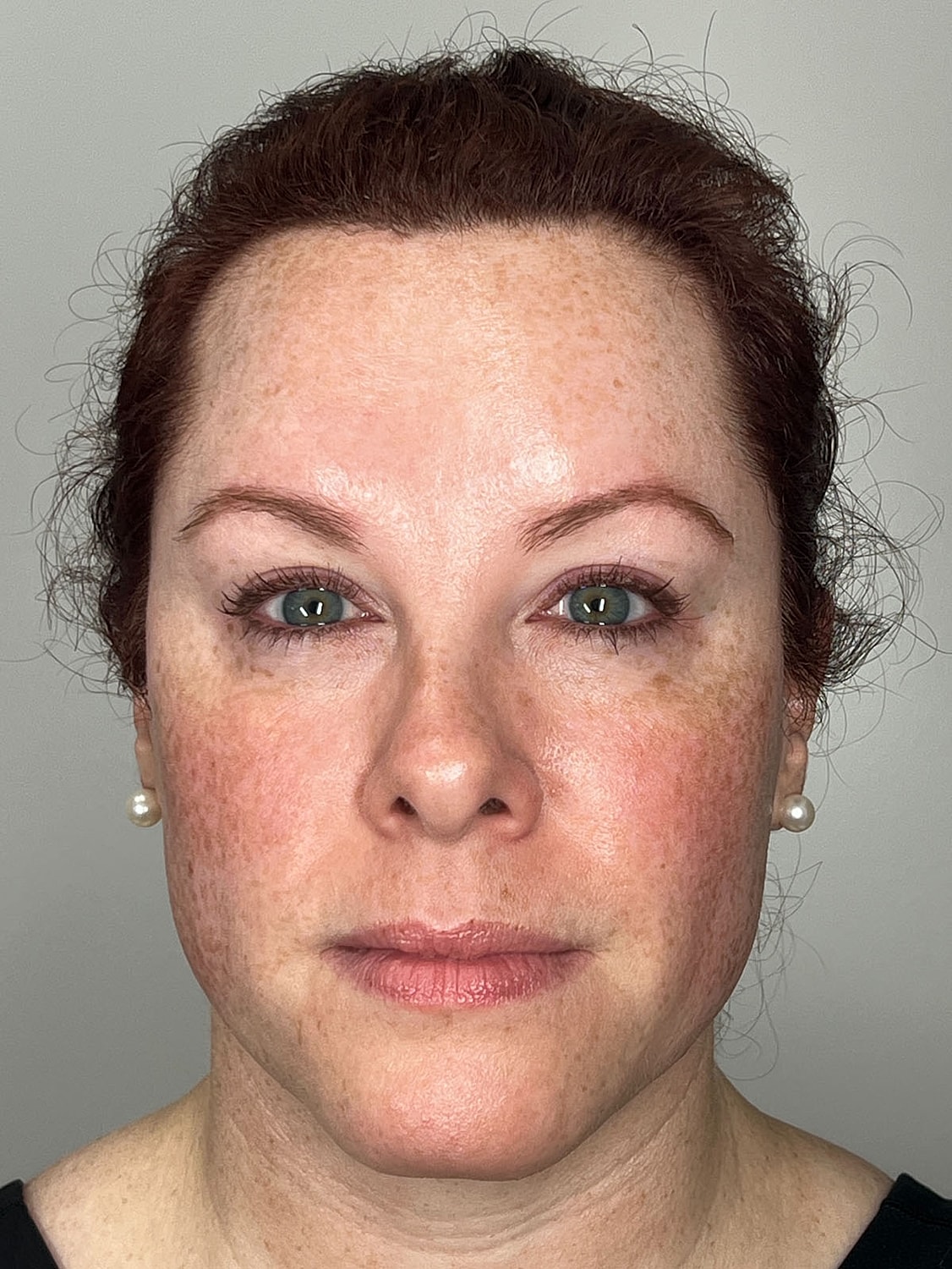 Wrinkle Treatments Before & After