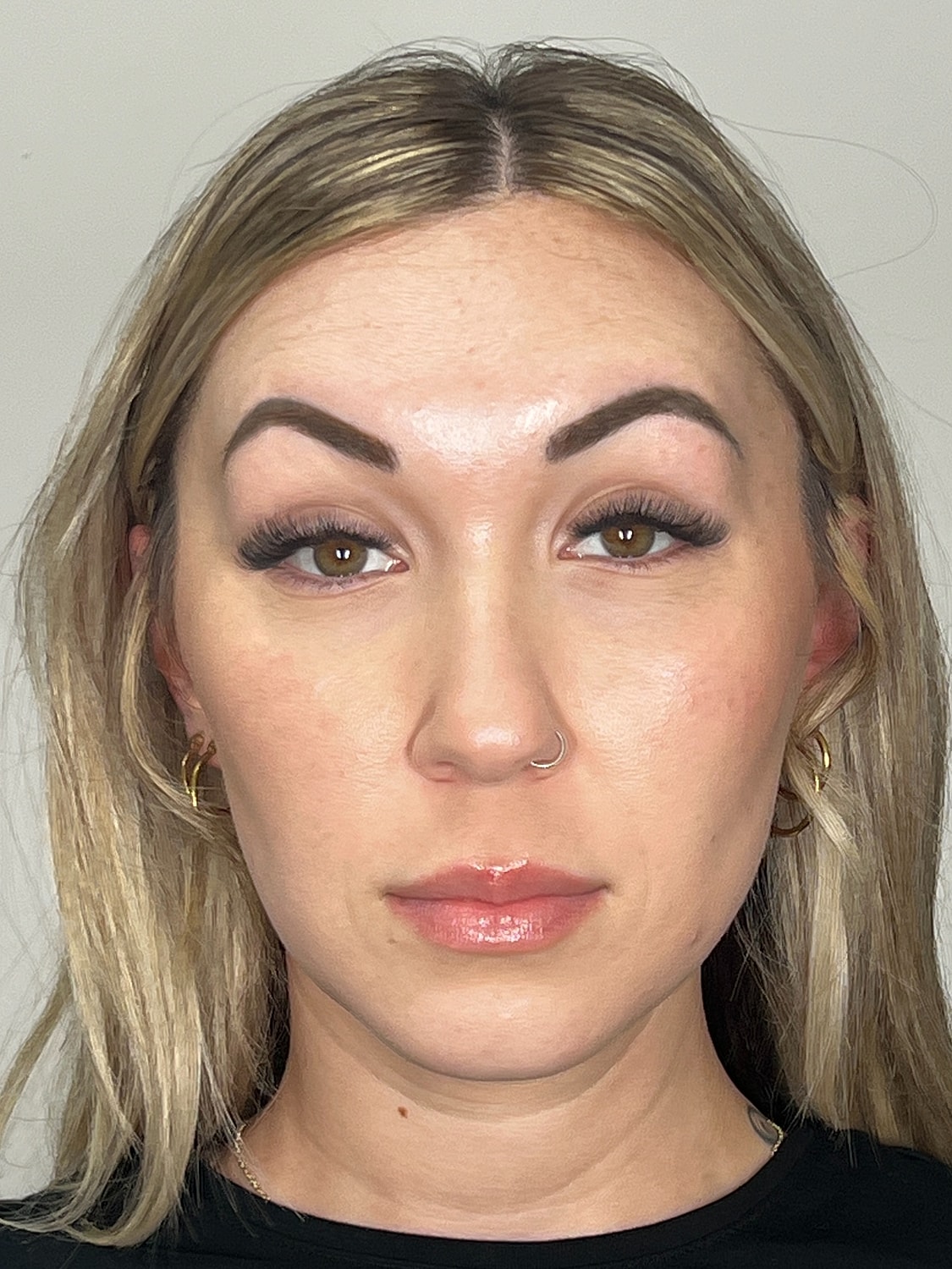 Wrinkle Treatments Before & After