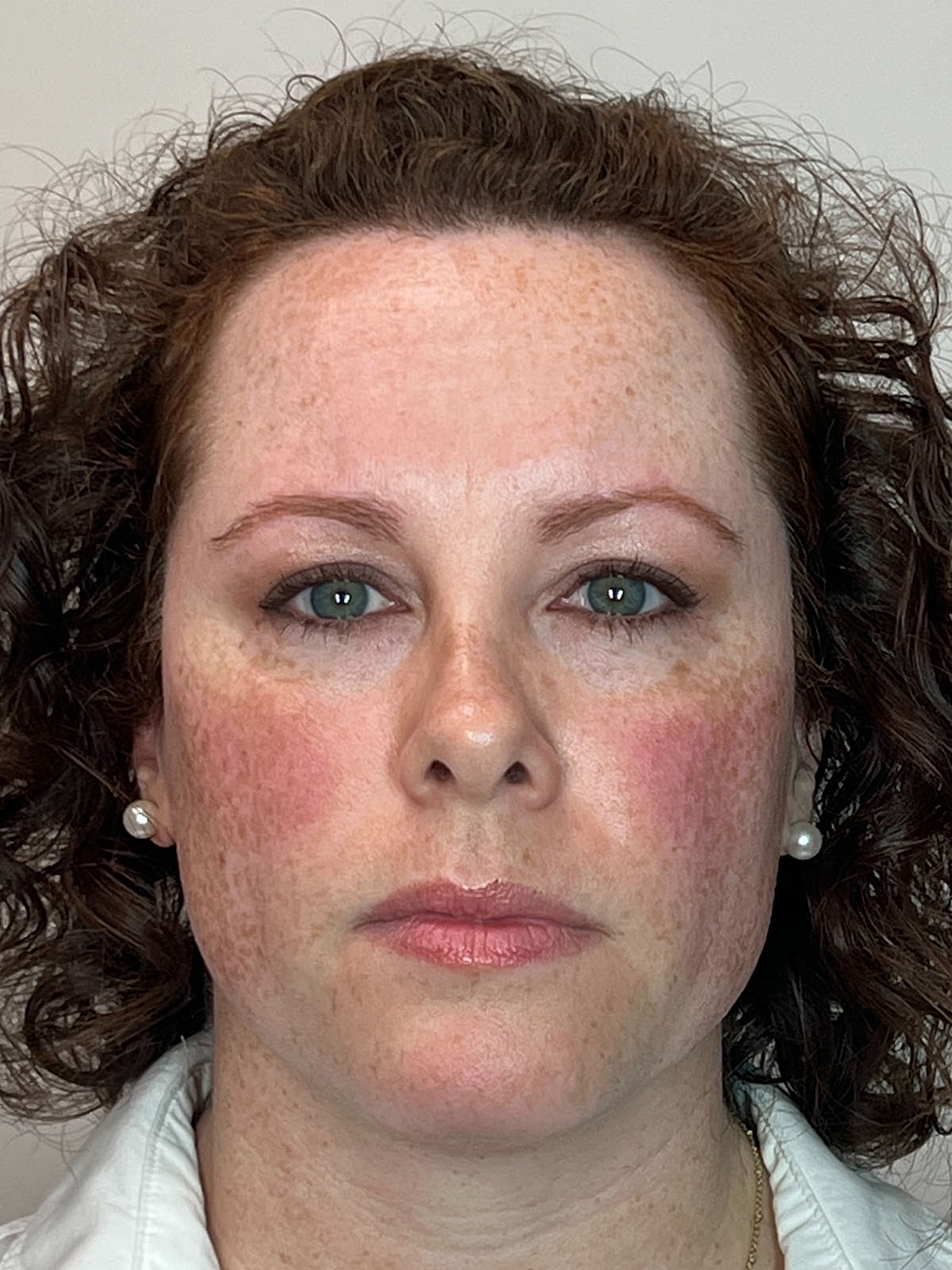 Wrinkle Treatments Before & After
