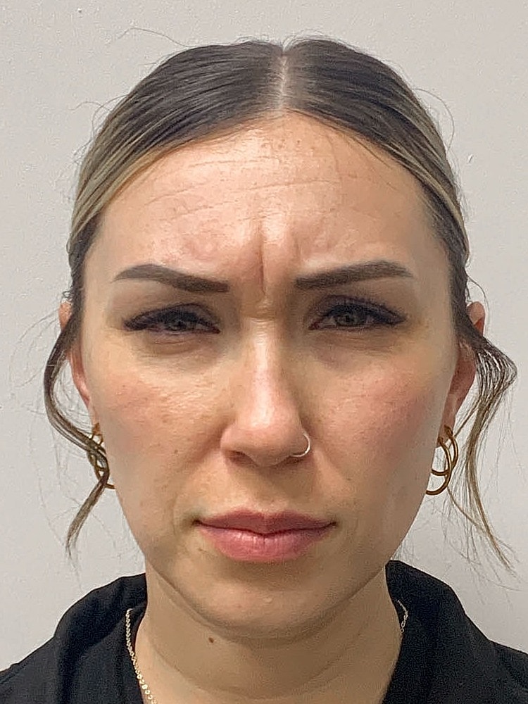 Wrinkle Treatments Before & After