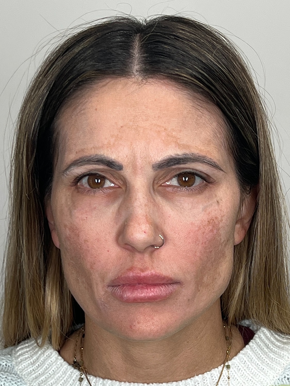 Wrinkle Treatments Before & After