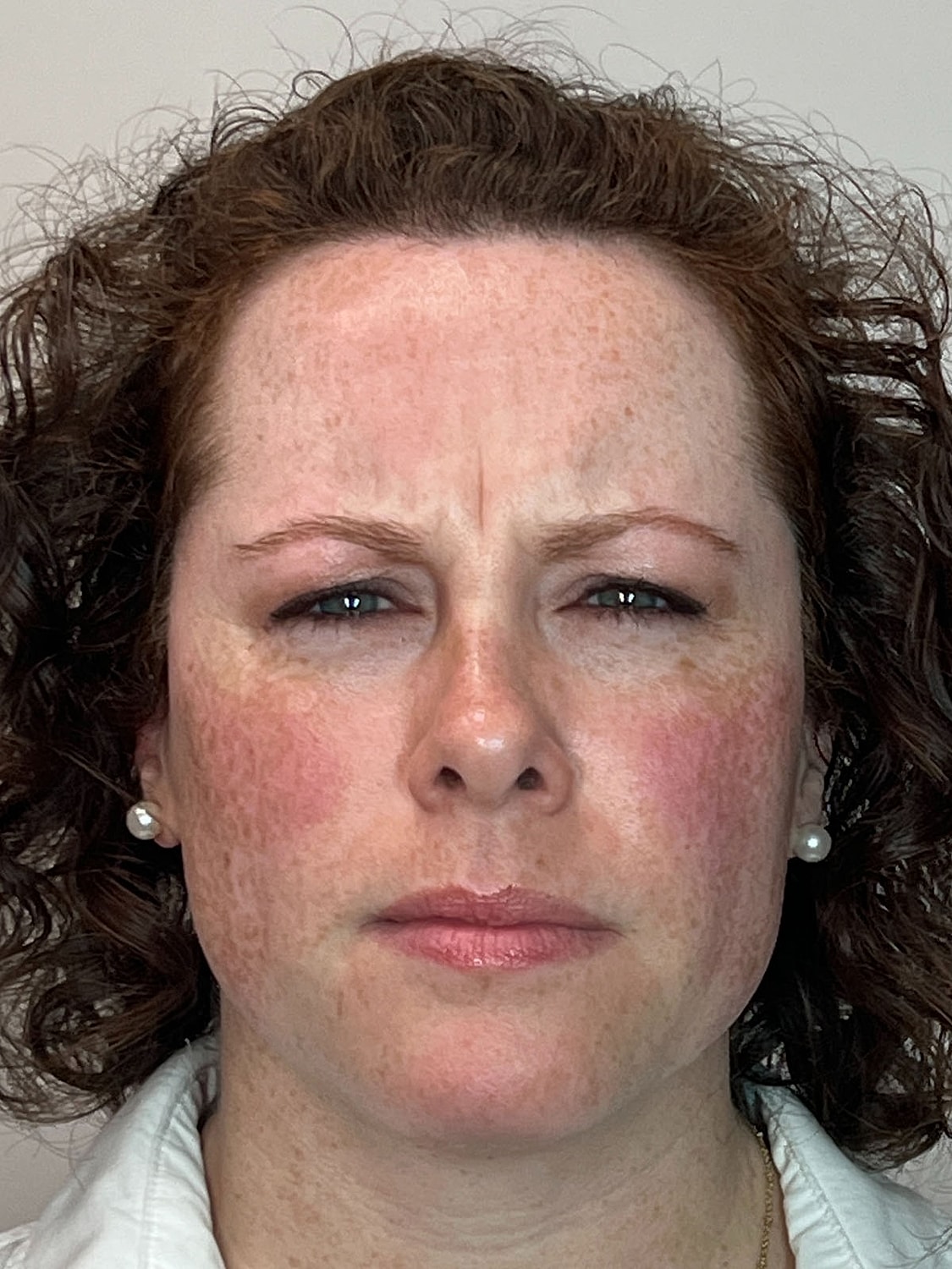 Wrinkle Treatments Before & After