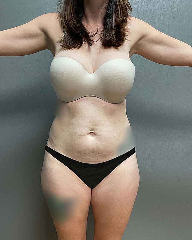 Liposuction Midsection Before & After