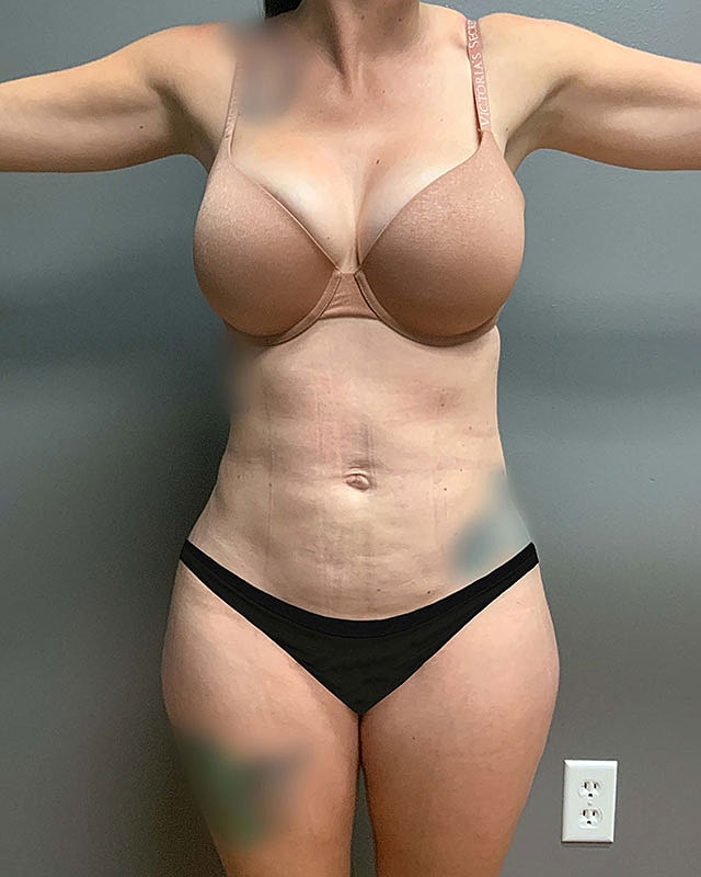 Liposuction Midsection Before & After