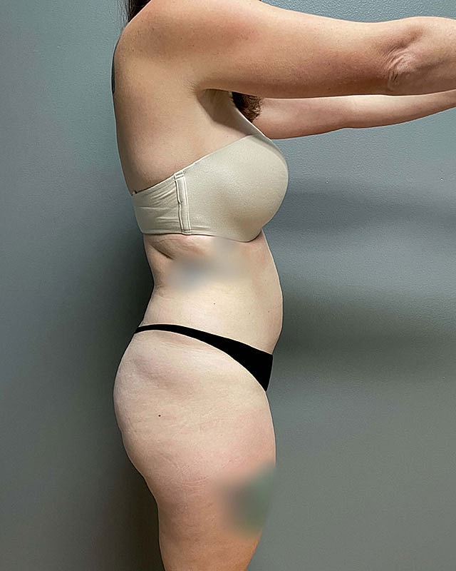 Liposuction Midsection Before & After