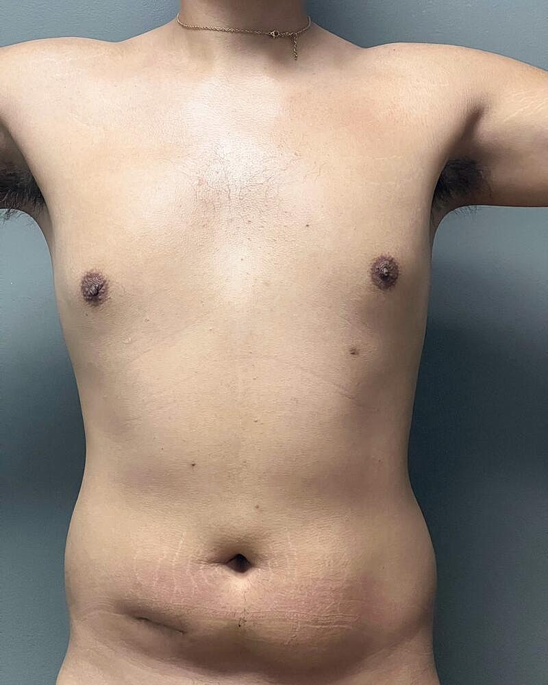 Liposuction Midsection Before & After