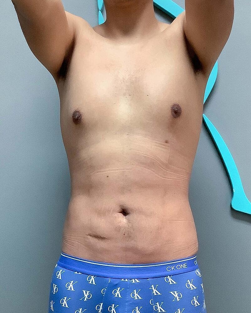 Liposuction Midsection Before & After