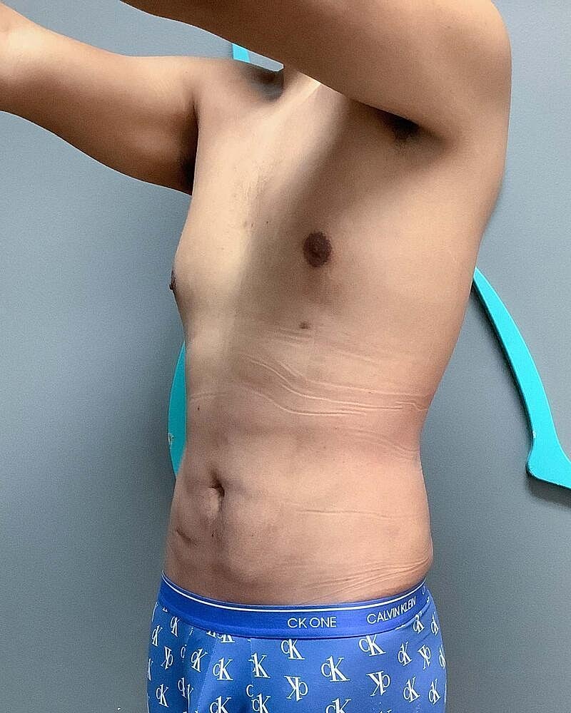 Liposuction Midsection Before & After