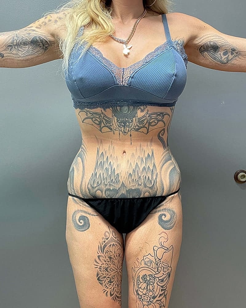 Liposuction Midsection Before & After