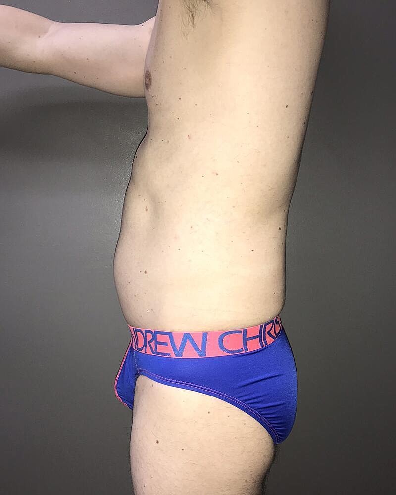 Liposuction Midsection Before & After
