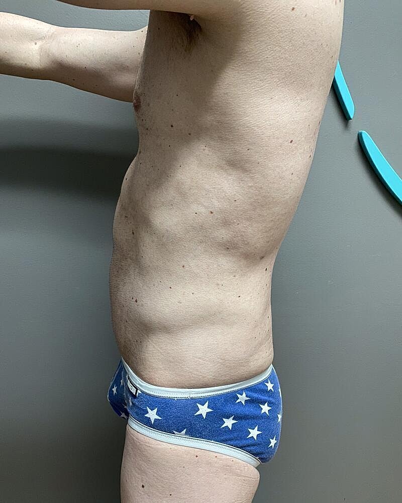 Liposuction Midsection Before & After