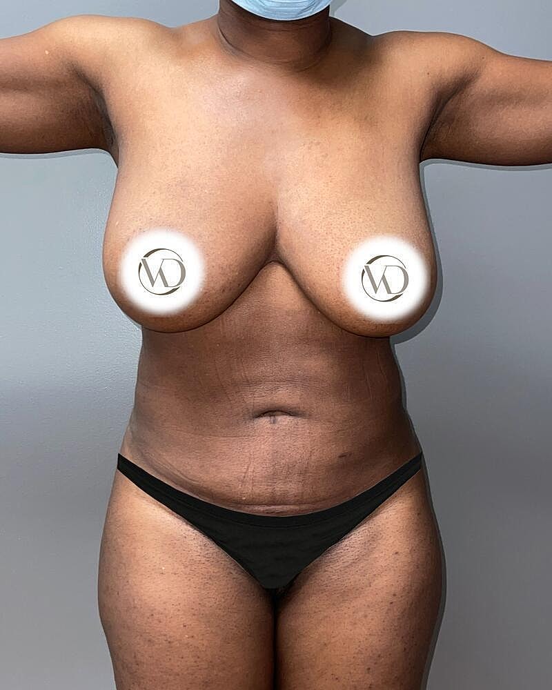 Liposuction Midsection Before & After