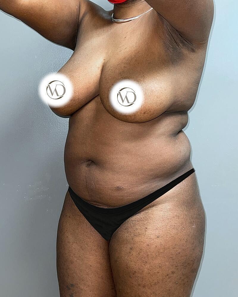 Liposuction Midsection Before & After
