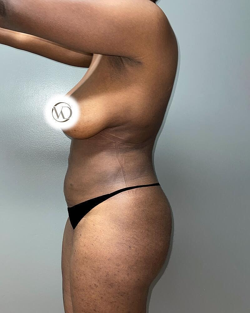 Liposuction Midsection Before & After