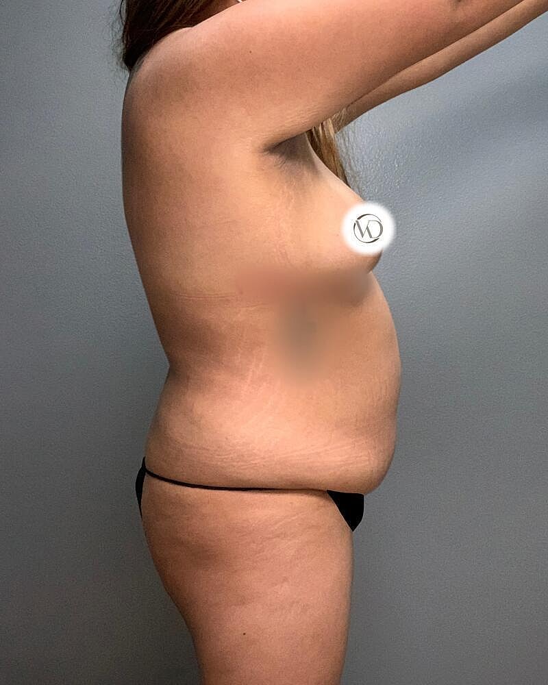 Liposuction Midsection Before & After
