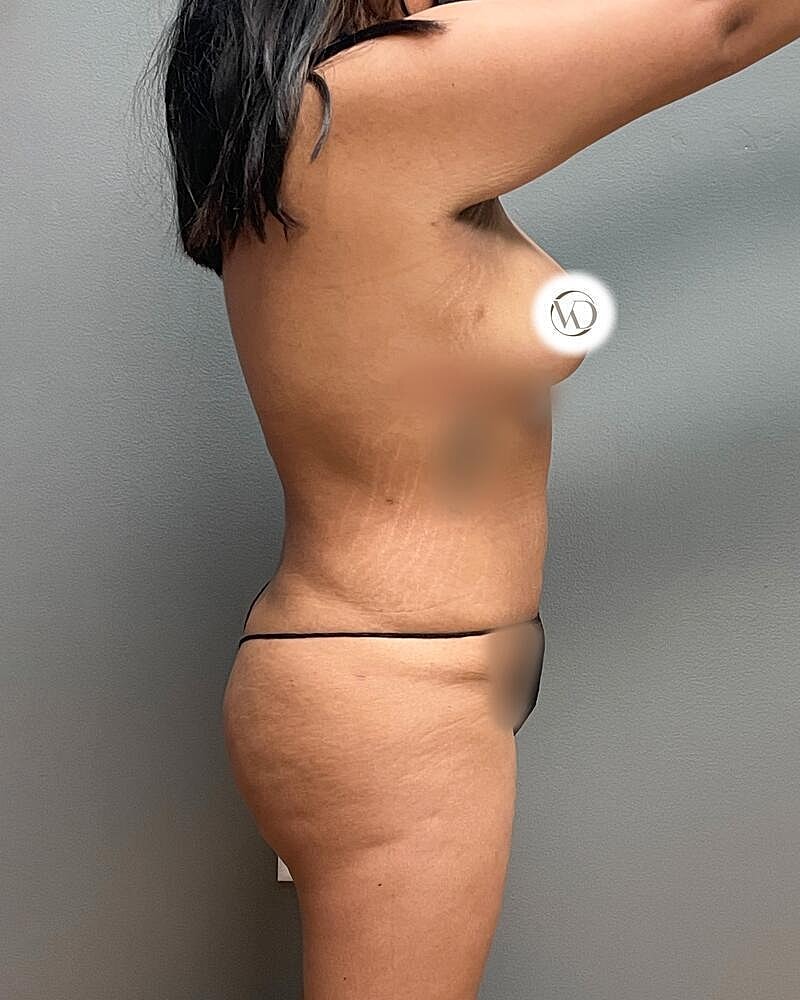 Liposuction Midsection Before & After