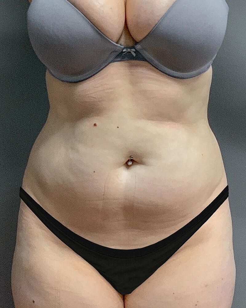Liposuction Midsection Before & After