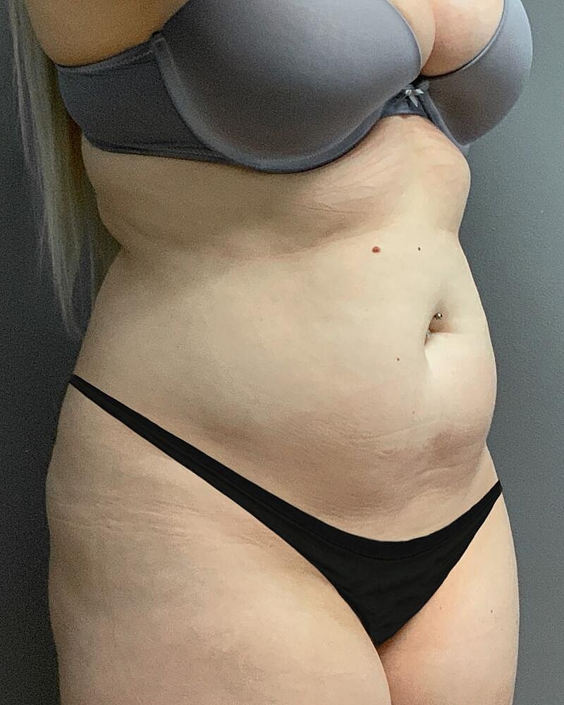Liposuction Midsection Before & After