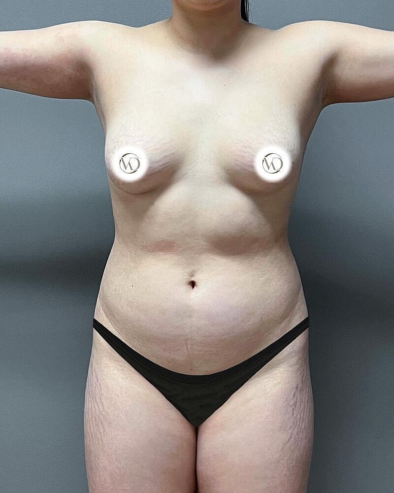 Liposuction Midsection Before & After