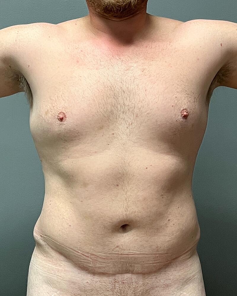 Liposuction Midsection Before & After